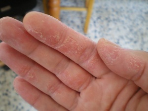 Stress linked to hand eczema but alcohol can help ...